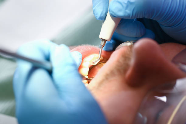 Best Dentist for Tooth Abscess  in Sandersville, GA