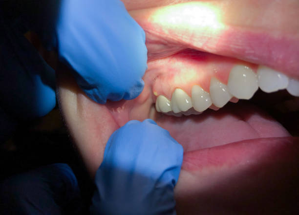 Best Broken Tooth Emergency  in Sandersville, GA